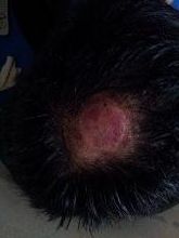 Bekas bekam di kepala